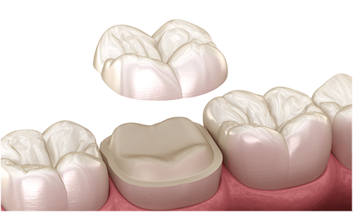 CAD/CAM冠・インレーとは