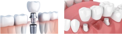 固定式の人工歯
