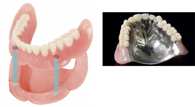 自費の総入れ歯