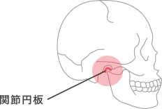 顎関節症のイラスト