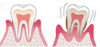 歯周病イラスト