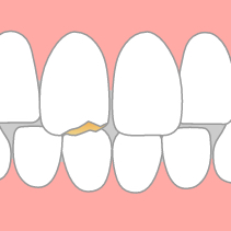 歯の外傷